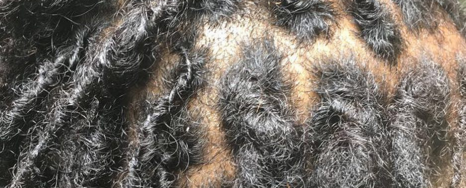 Inside : Dry Scalp and Locs