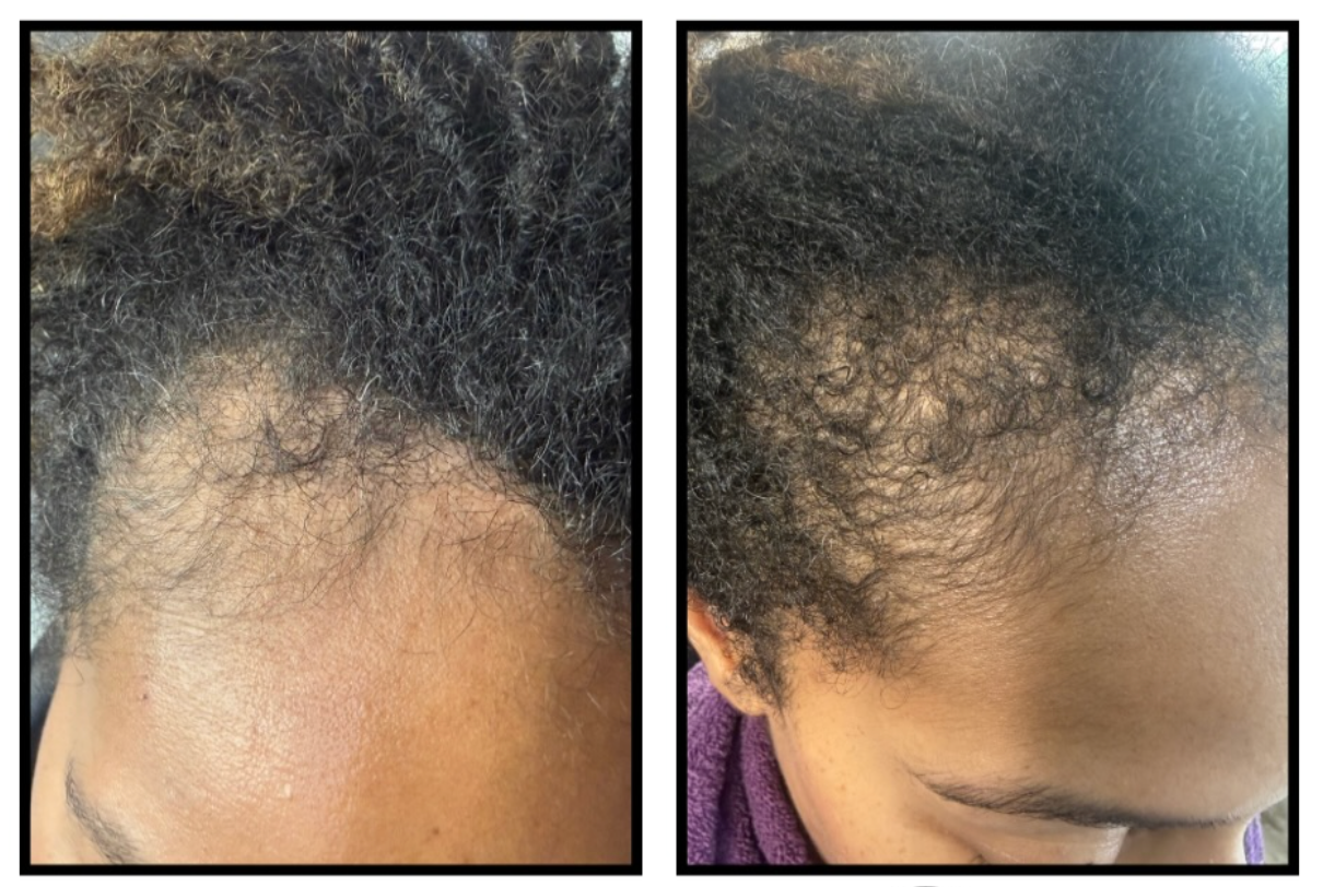 Why Your Locs Are Thinning at the Root (and How to Stop It)
