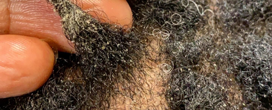 How to Determine if You Have Mold In Your Locs